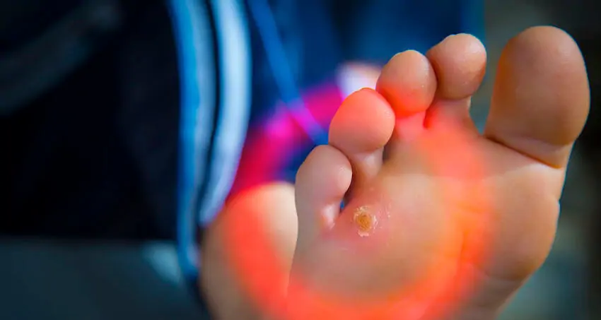 corns on the feet 1 115937 corns on the feet 1 115937